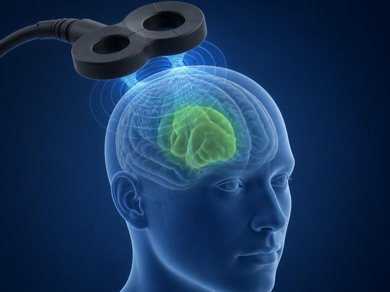 Ilustración de una bobina de TMS sobre la cabeza con la corteza prefrontal dorsolateral destacada